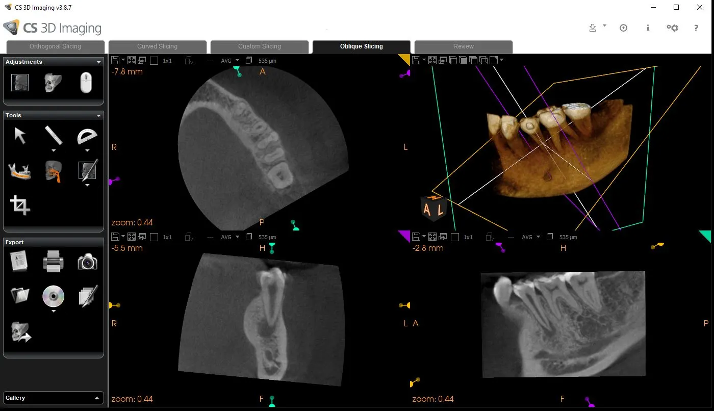 Cone Beam CT Image
